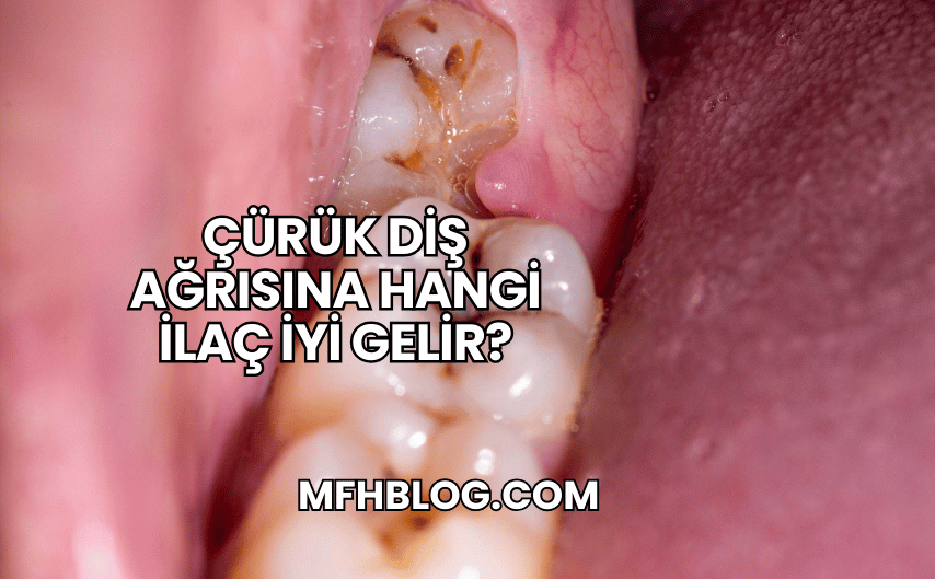 Çürük Diş Ağrısına Hangi İlaç İyi Gelir?