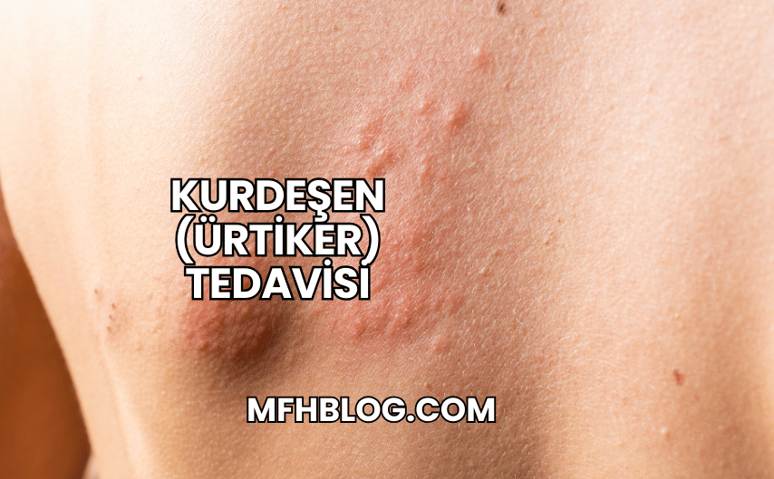 Kurdeşen (Ürtiker) Tedavisi