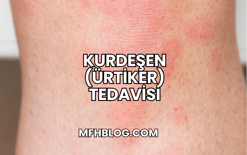 Kurdeşen (Ürtiker) Tedavisi