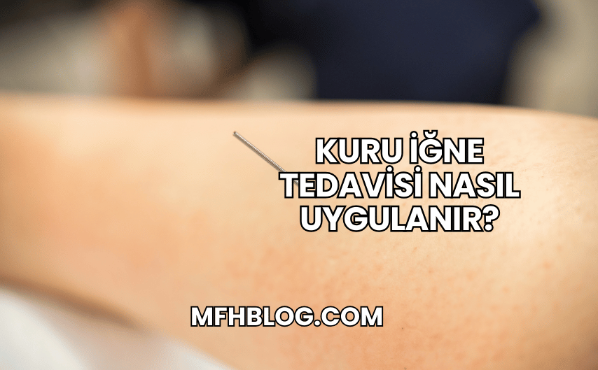 Kuru İğne Tedavisi Nasıl Uygulanır?