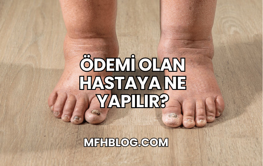 Ödemi Olan Hastaya Ne Yapılır?