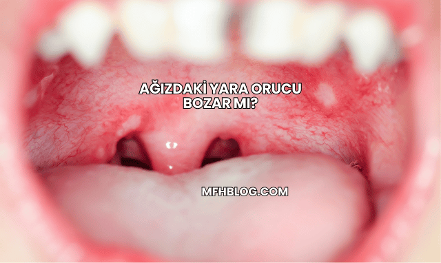 Ağızdaki Yara Orucu Bozar mı?